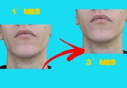 4 razones por las que no te funciona minoxidil en solución para barba