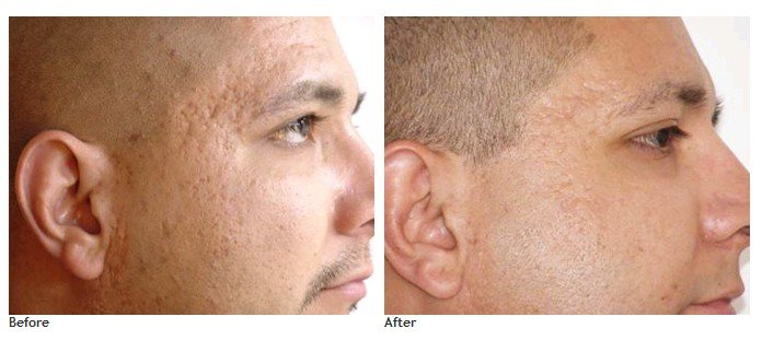 Dermaroller 3 en 1 - Estrias Celulitis Acne - 4