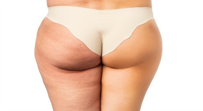 Dermaroller 3 en 1 - Estrias Celulitis Acne - 5