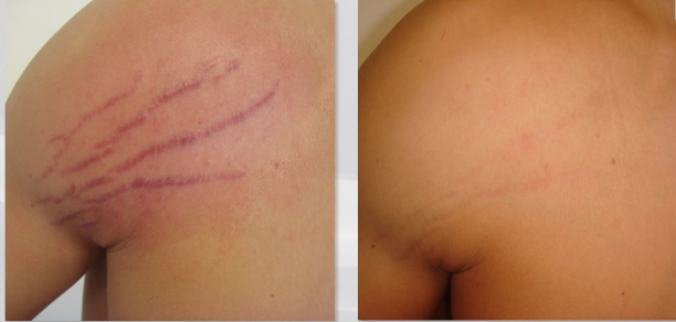 Dermaroller 3 en 1 - Estrias Celulitis Acne - 6