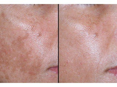 Dermaroller 3 en 1 - Estrias Celulitis Acne - 7