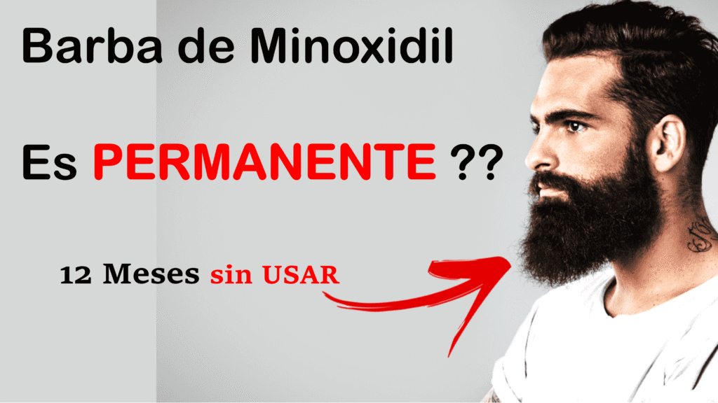 los resultados con minoxidil son permanentes